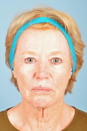 Facelift Before & After Image