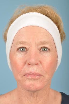 Facelift Before & After Image