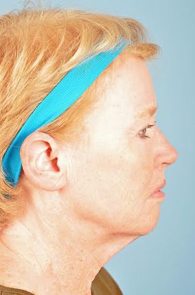 Facelift Before & After Image