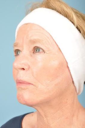 Facelift Before & After Image