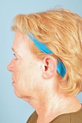 Facelift Before & After Image