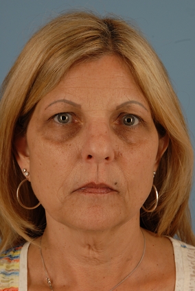 Facelift Before & After Image