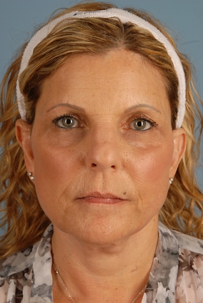 Facelift Before & After Image