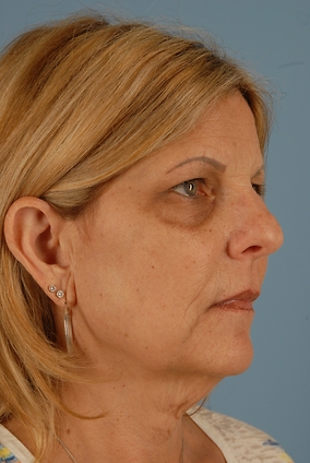 Facelift Before & After Image