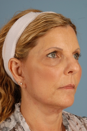 Facelift Before & After Image