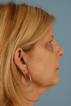 Facelift Before & After Image