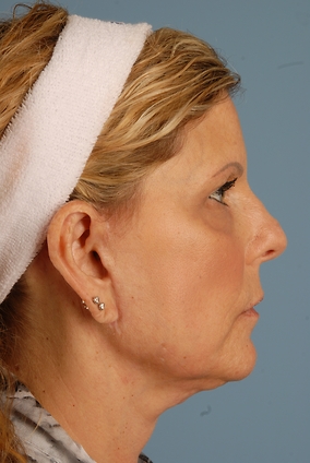 Facelift Before & After Image