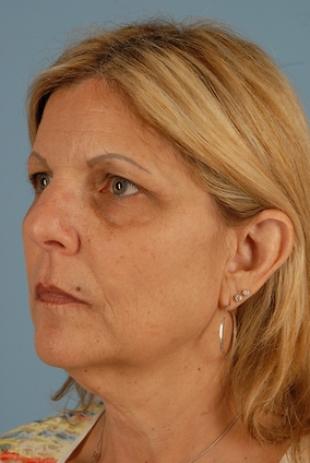 Facelift Before & After Image