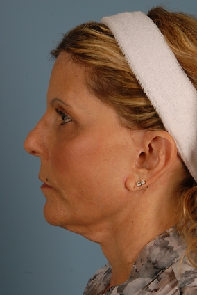 Facelift Before & After Image