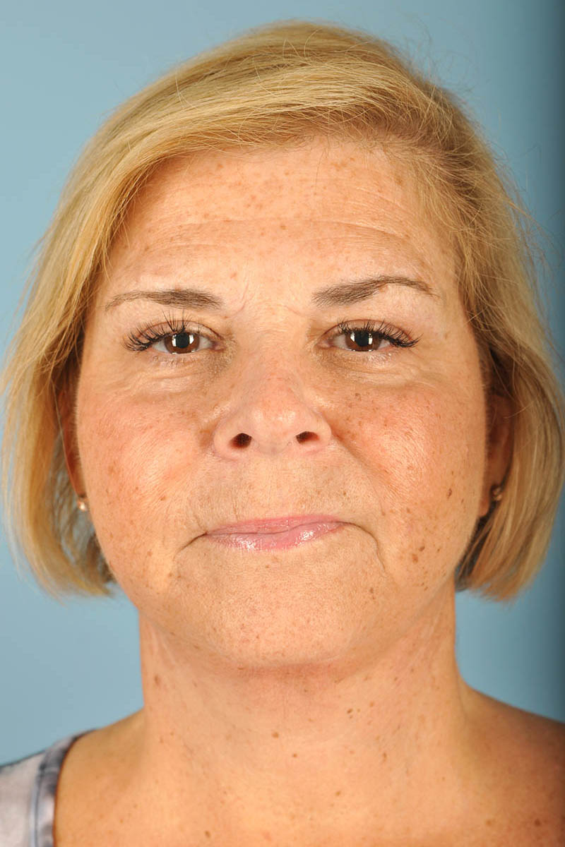 Facelift Before & After Image