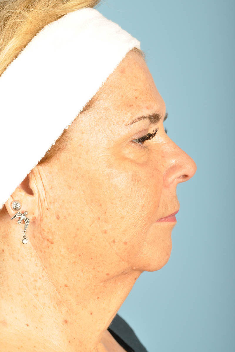Facelift Before & After Image