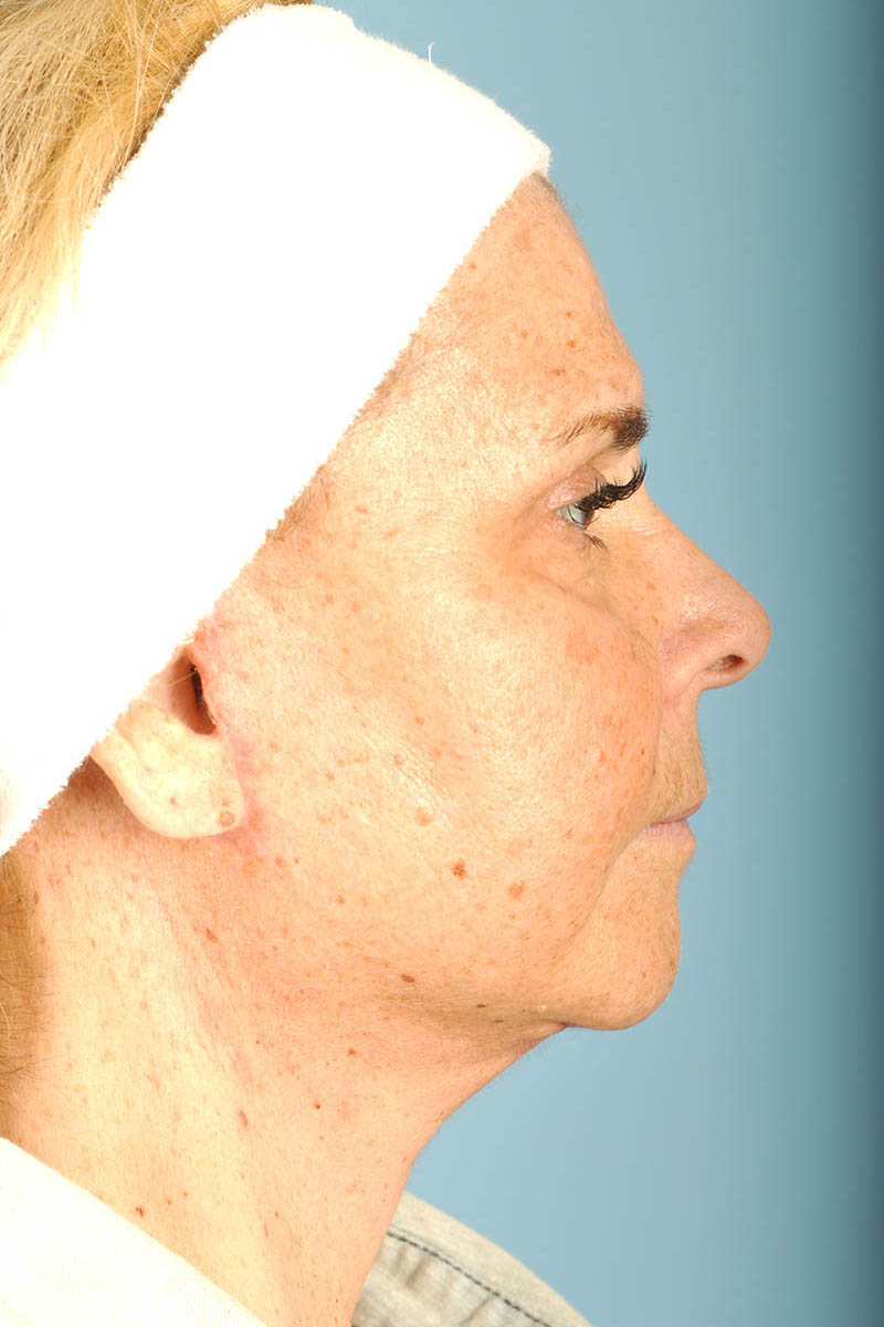 Facelift Before & After Image