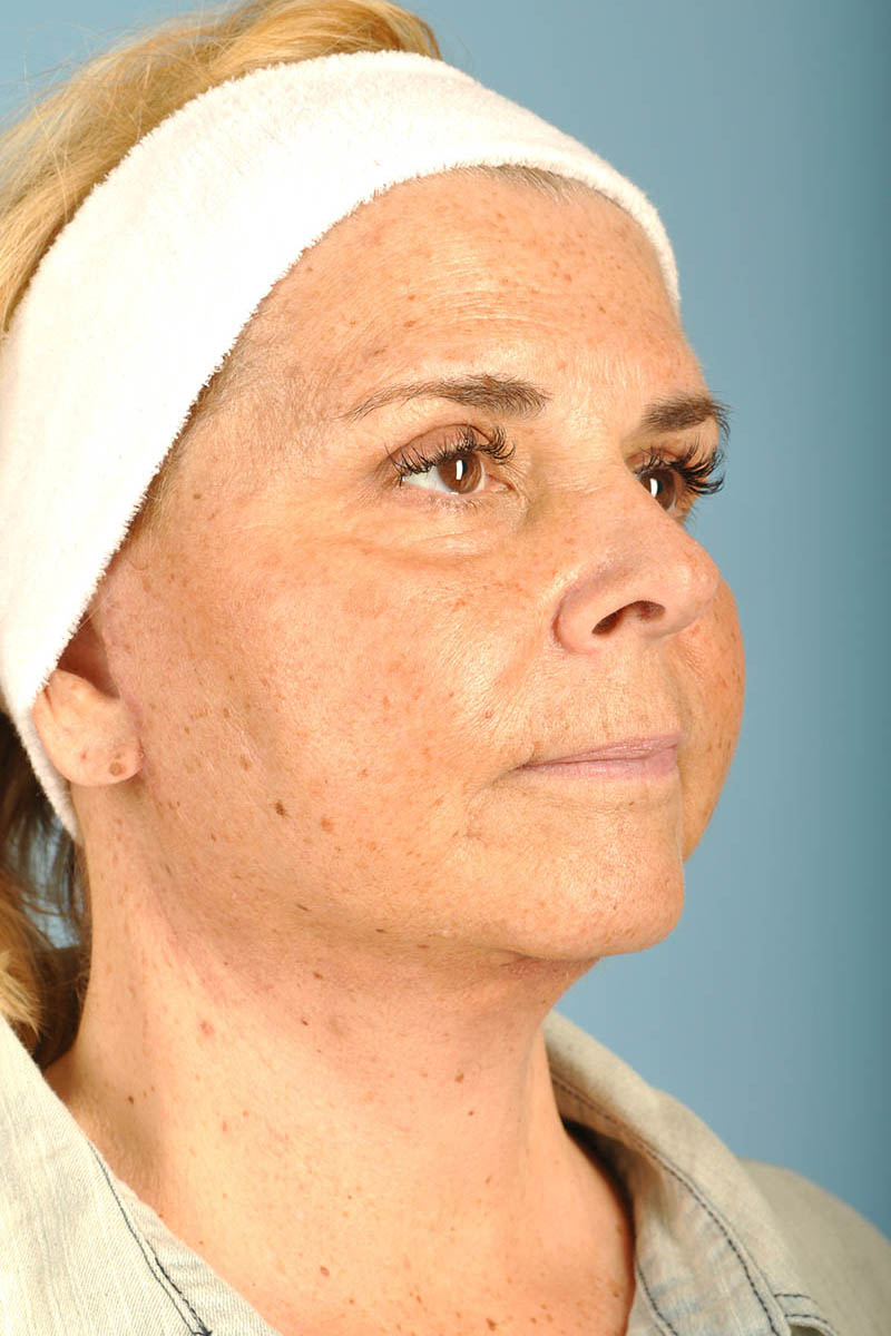 Facelift Before & After Image