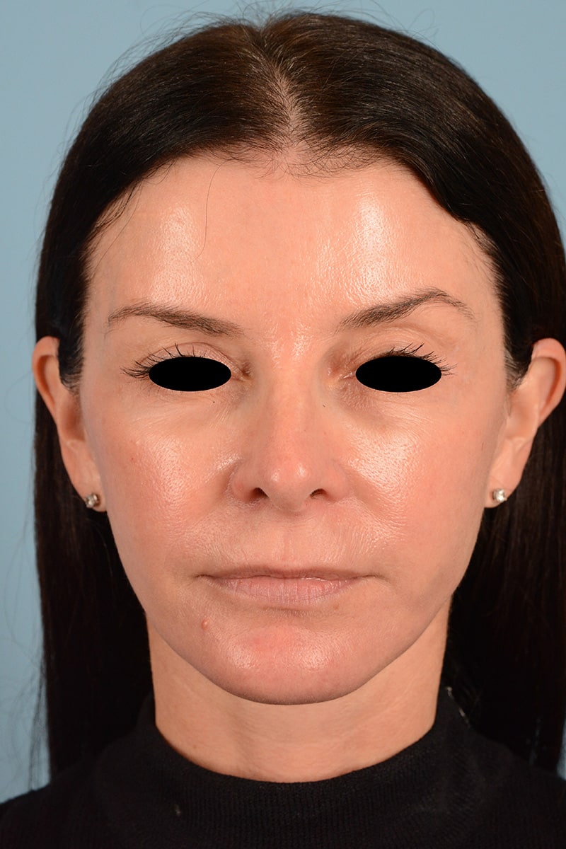 Facelift Before & After Image