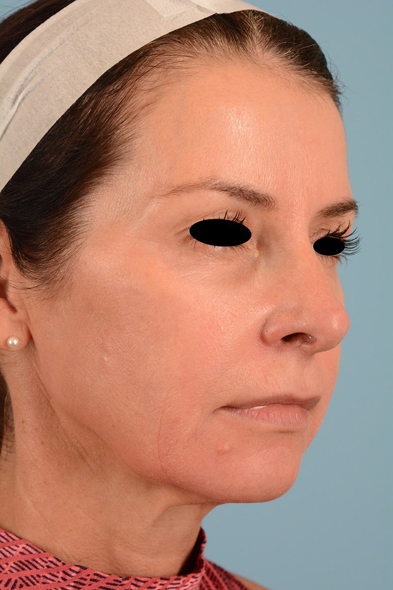 Facelift Before & After Image