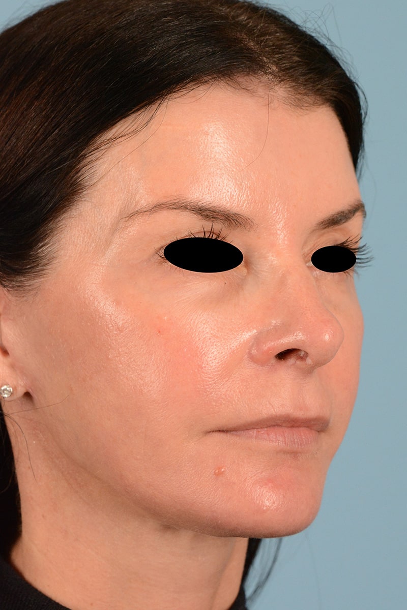 Facelift Before & After Image