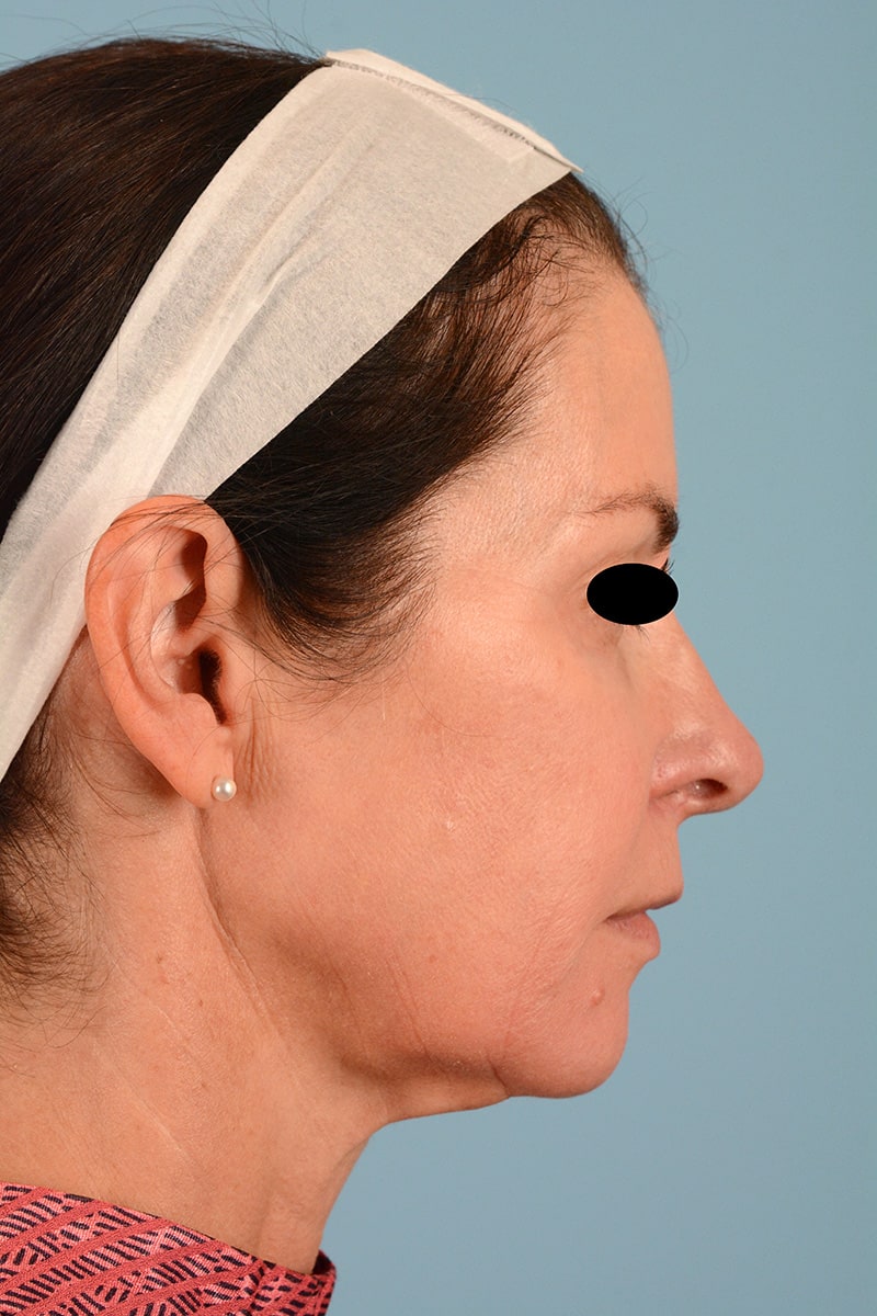 Facelift Before & After Image