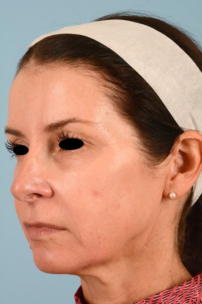 Facelift Before & After Image