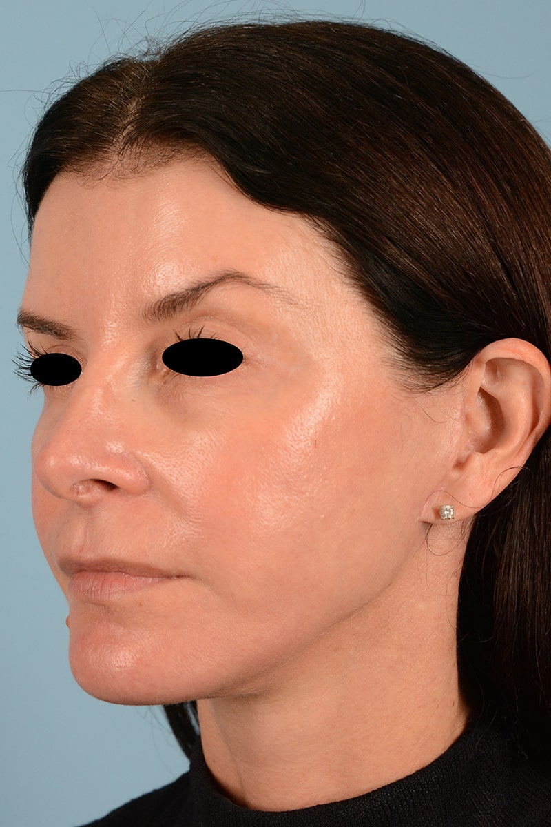 Facelift Before & After Image