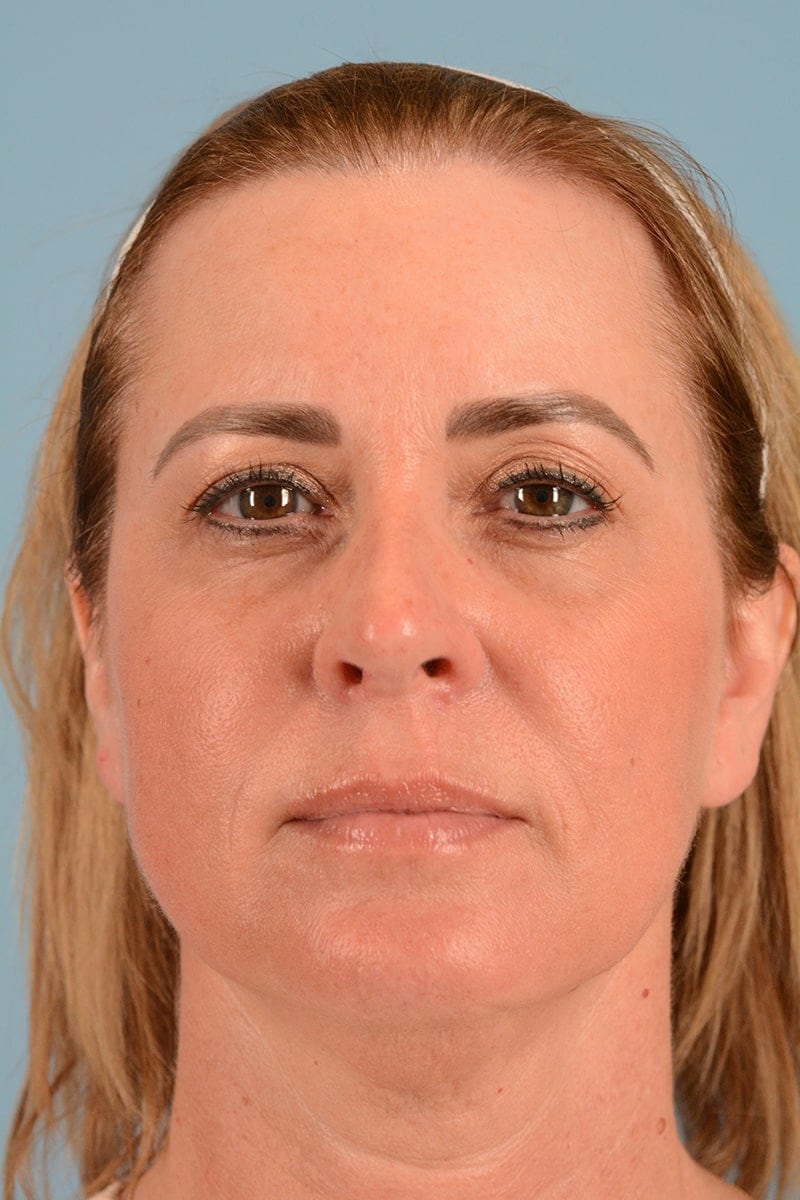 Facelift Before & After Image