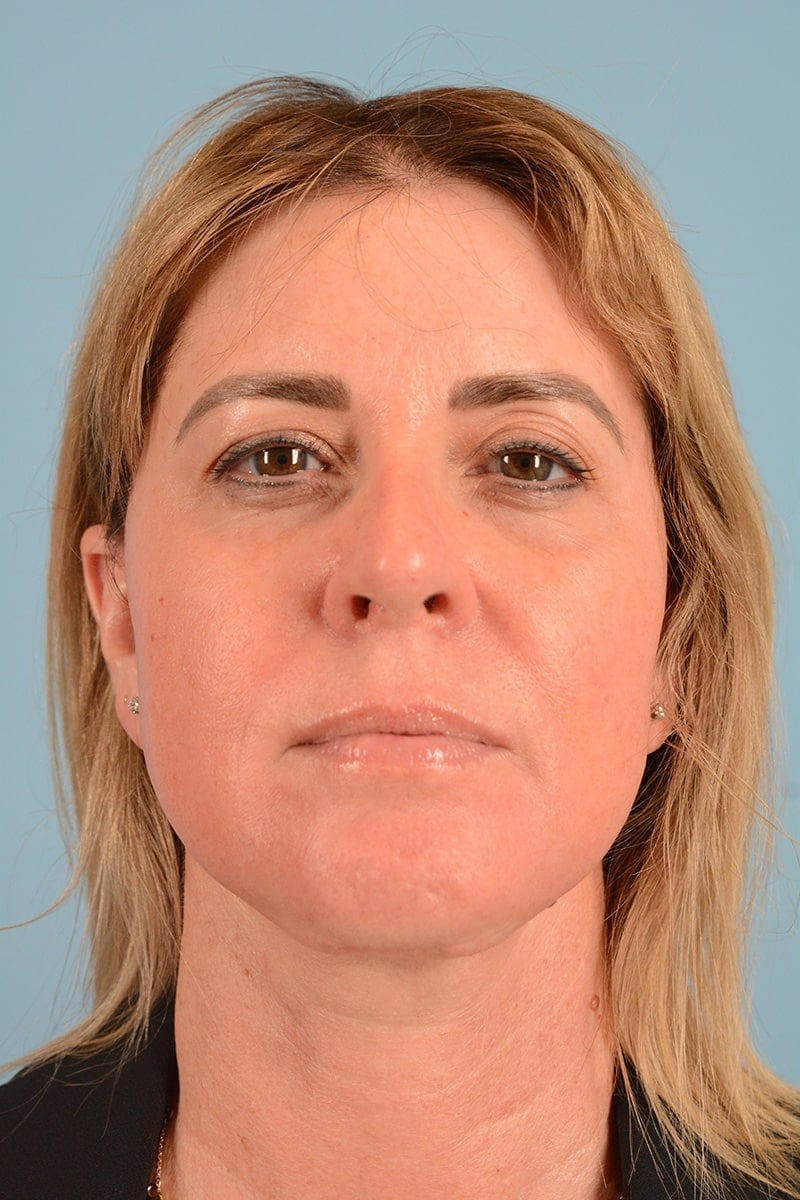 Facelift Before & After Image