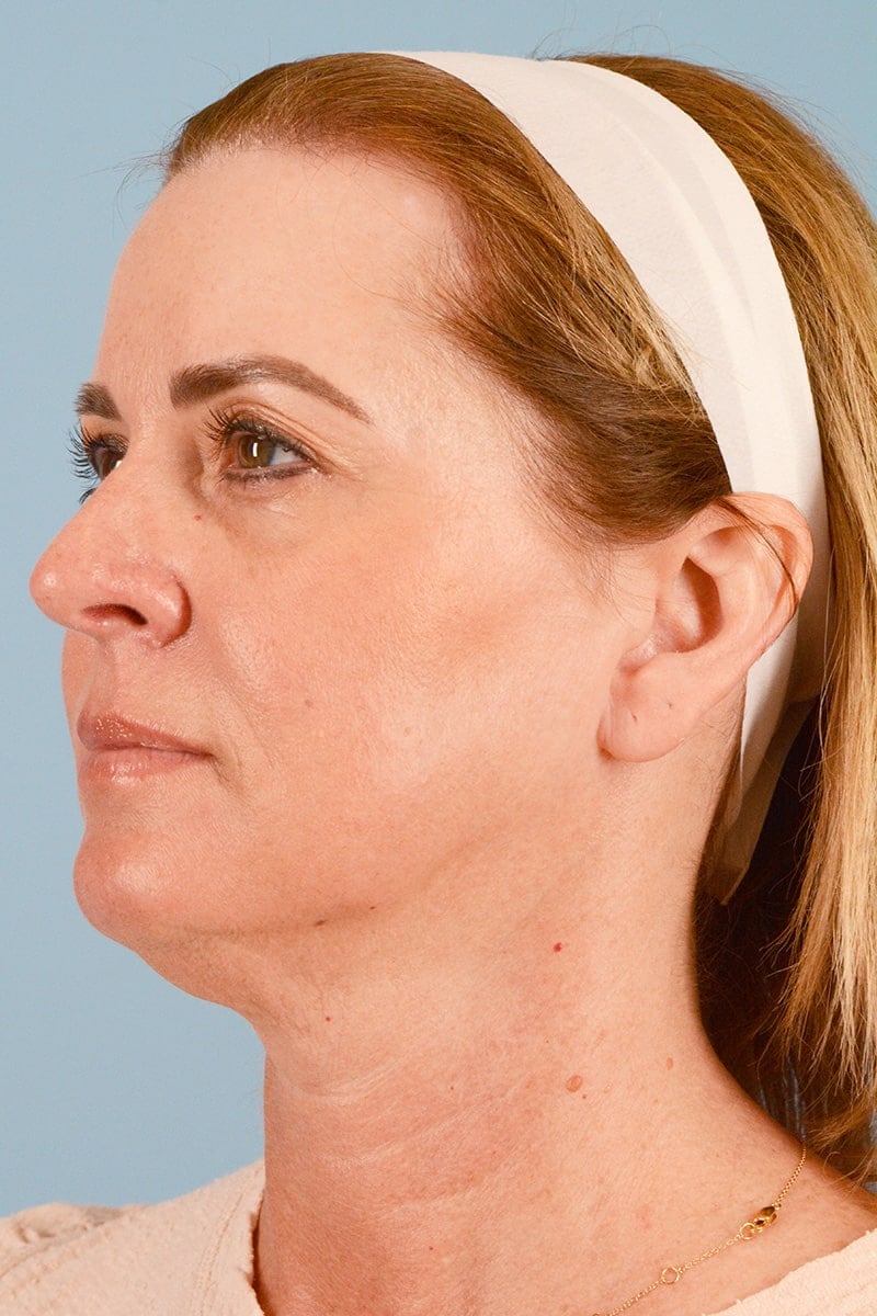 Facelift Before & After Image