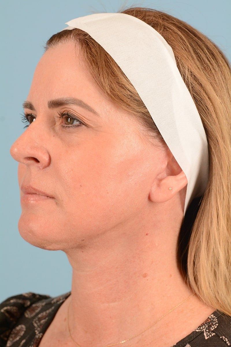 Facelift Before & After Image