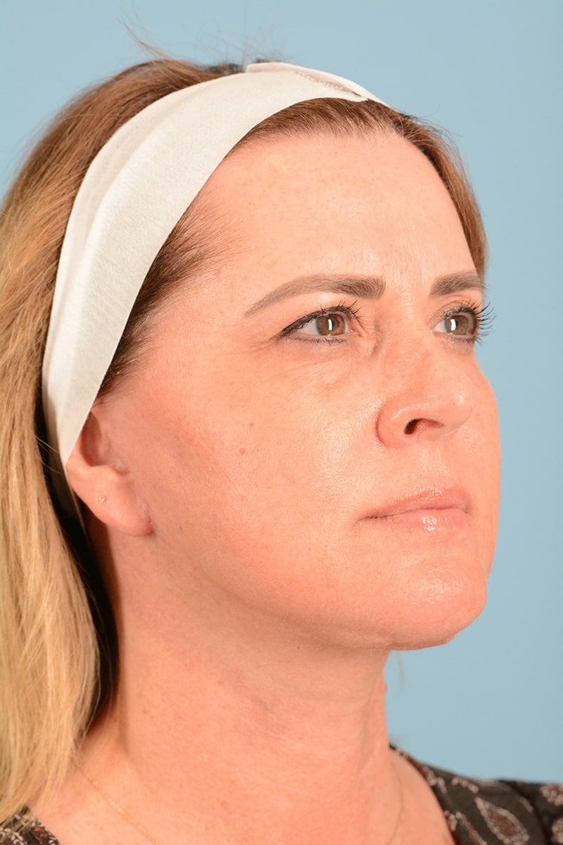 Facelift Before & After Image