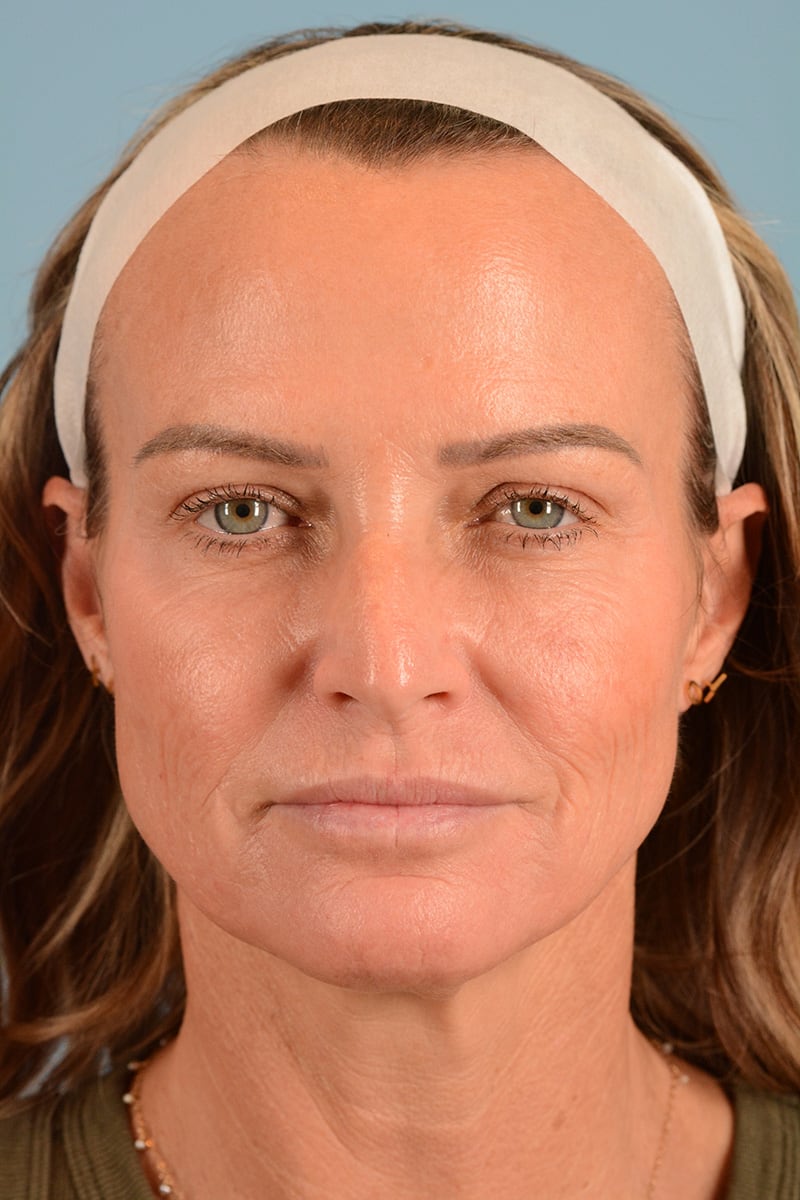 Facelift Before & After Image
