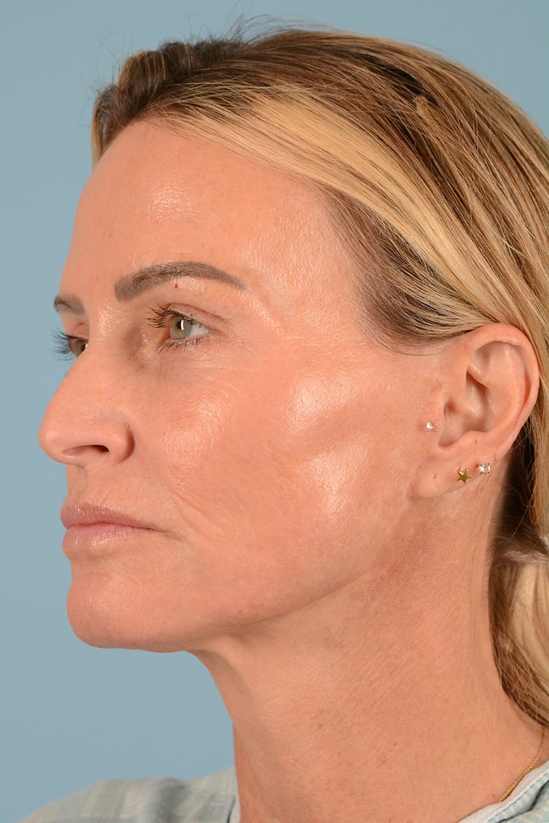 Facelift Before & After Image