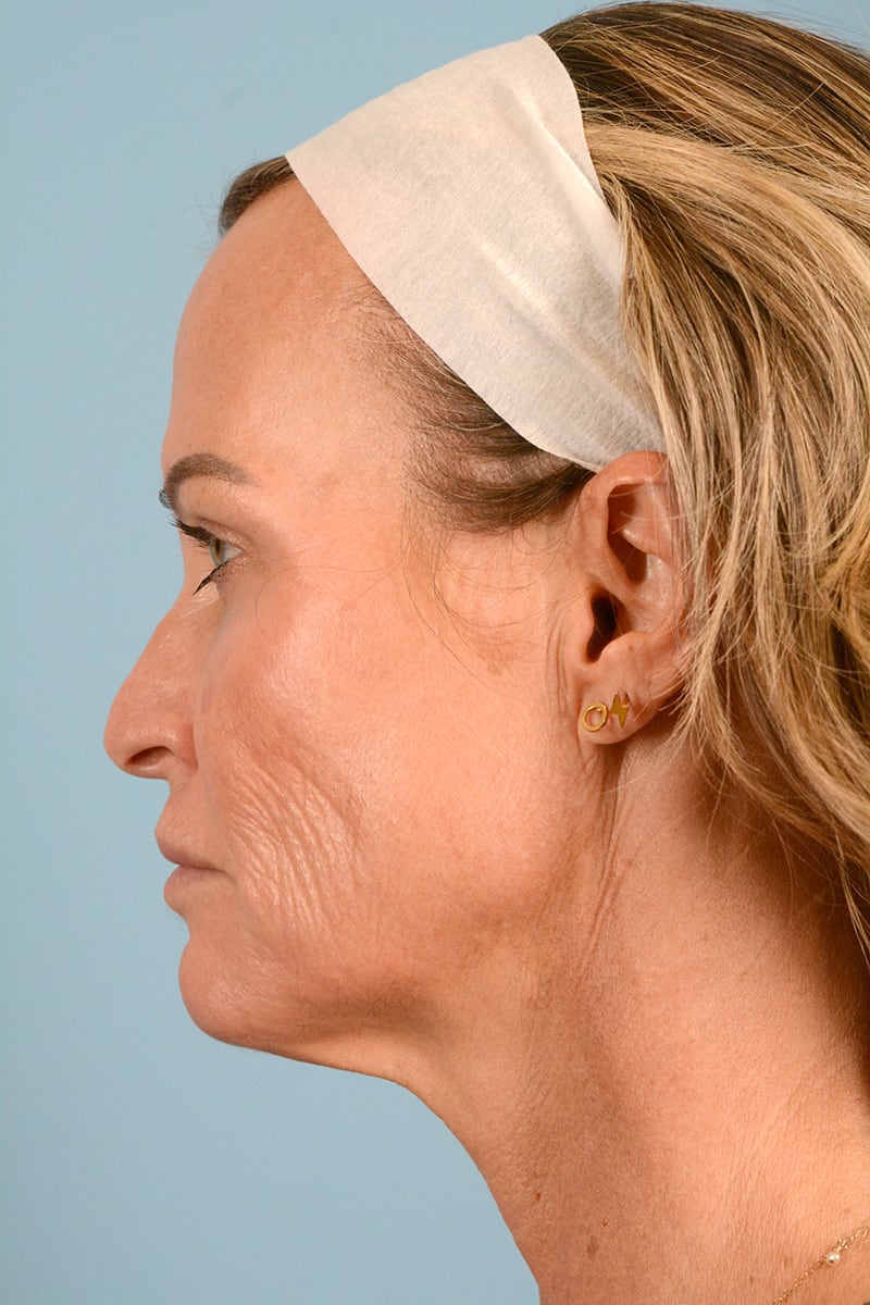 Facelift Before & After Image