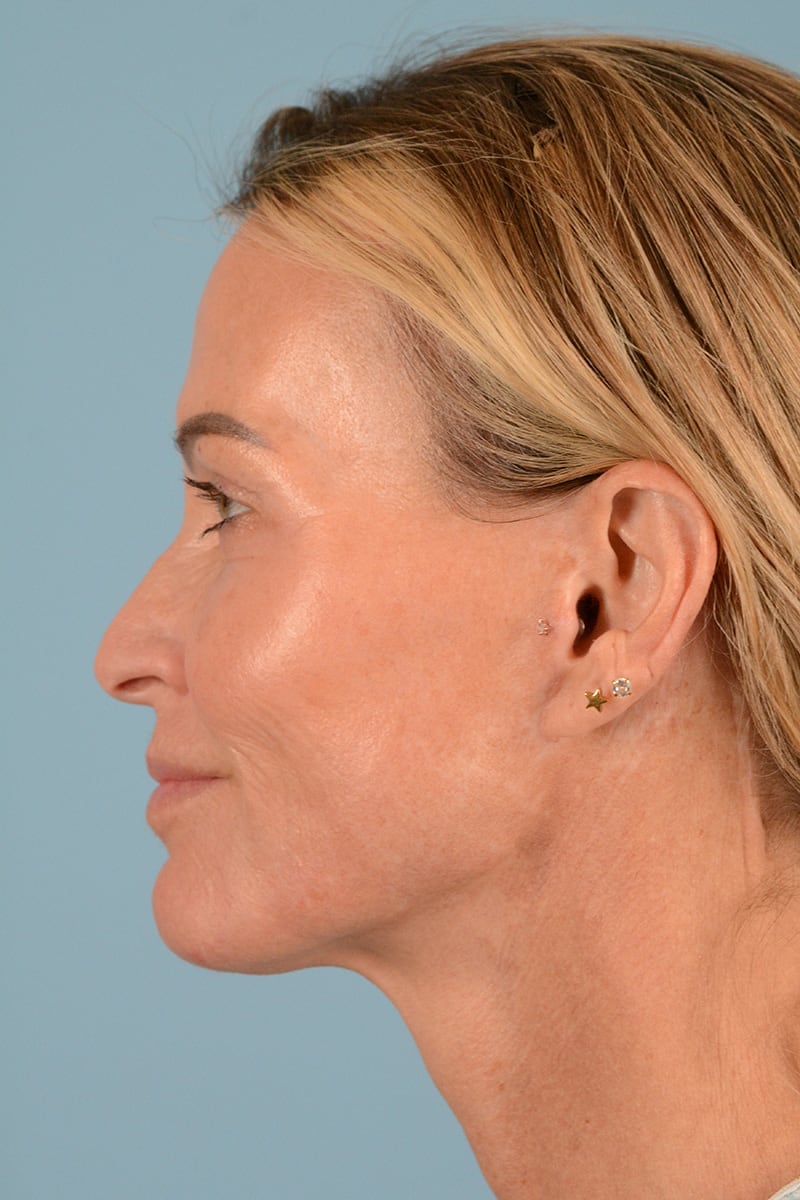 Facelift Before & After Image