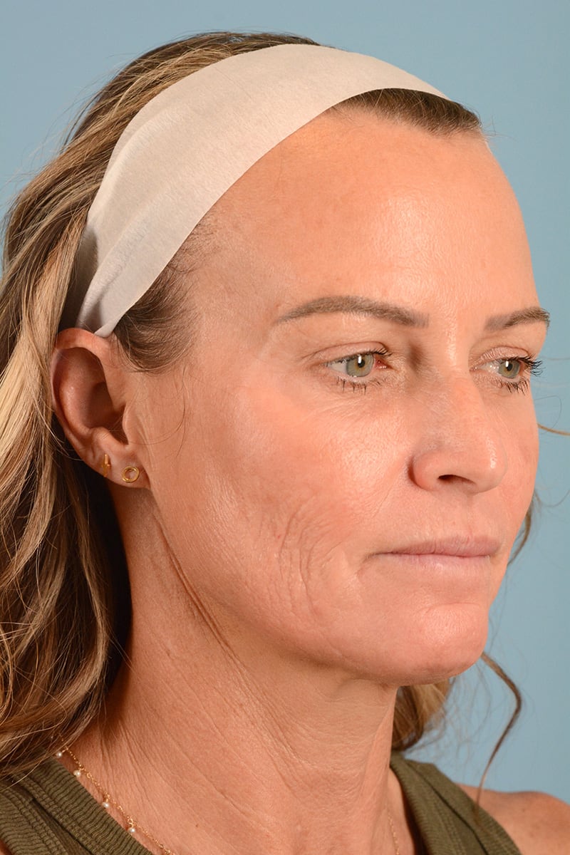 Facelift Before & After Image