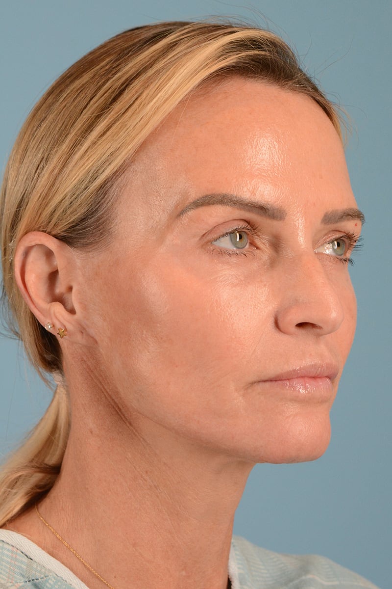Facelift Before & After Image