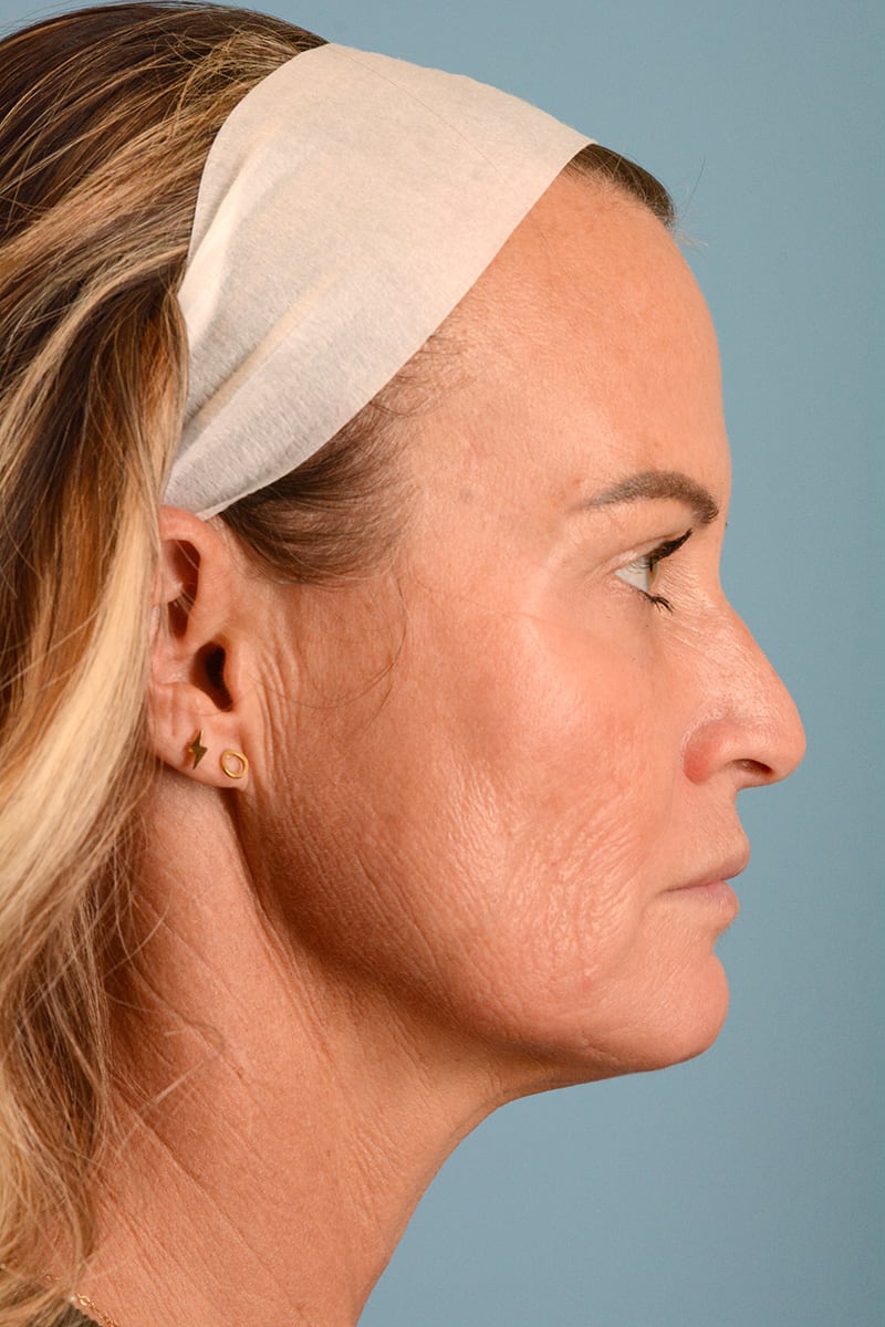 Facelift Before & After Image