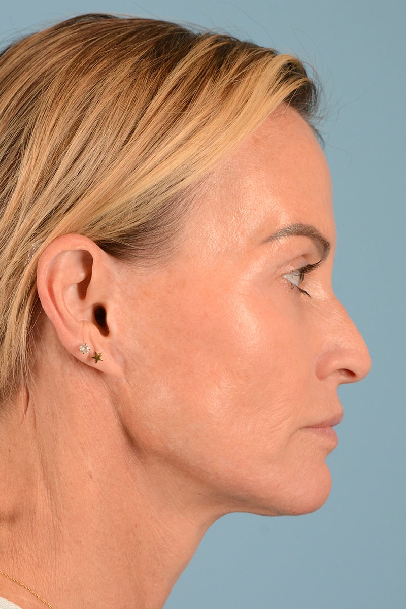 Facelift Before & After Image