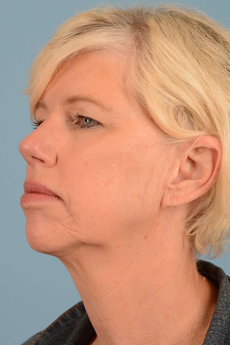 Facelift Before & After Image