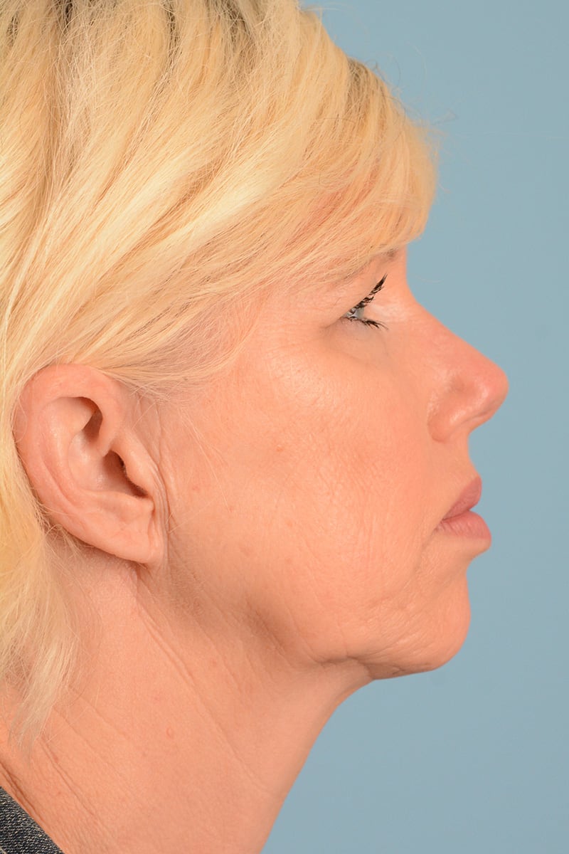 Facelift Before & After Image