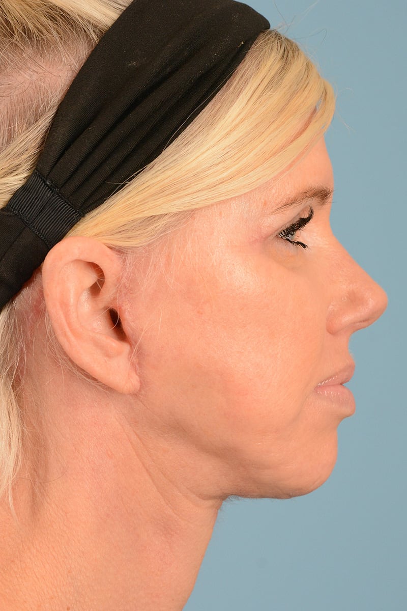 Facelift Before & After Image