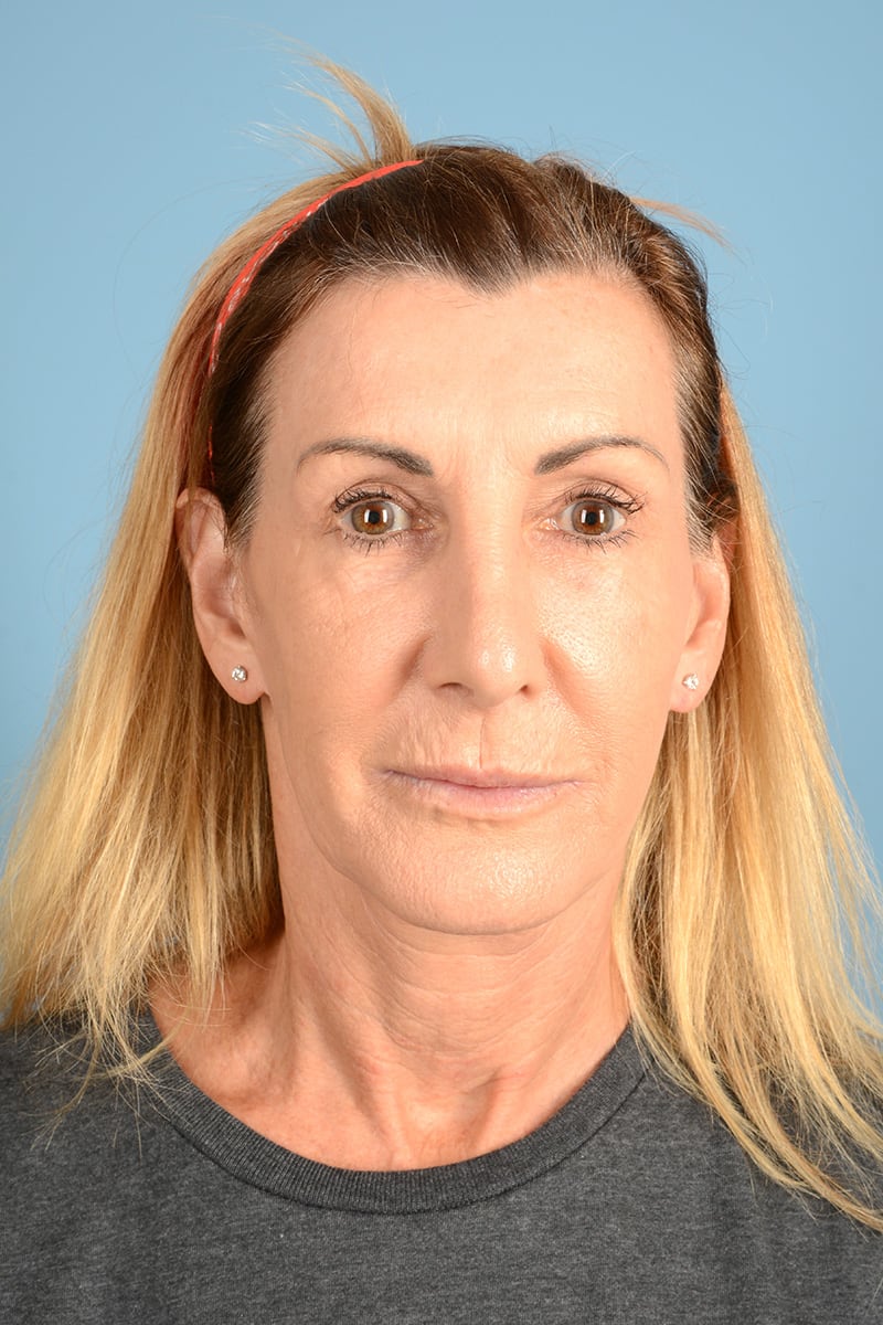 Facelift Before & After Image