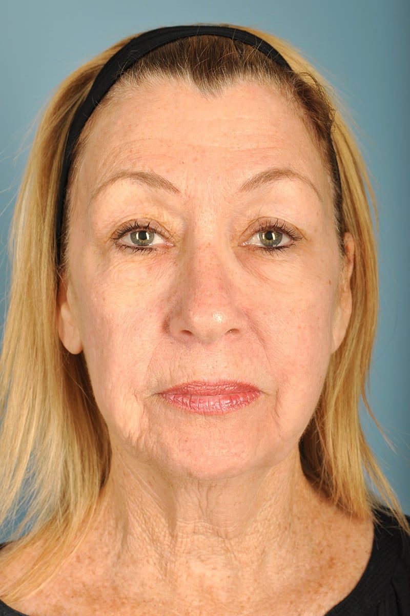 Facelift Before & After Image