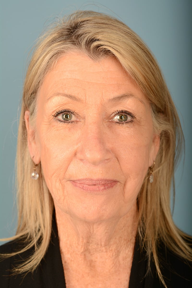 Facelift Before & After Image