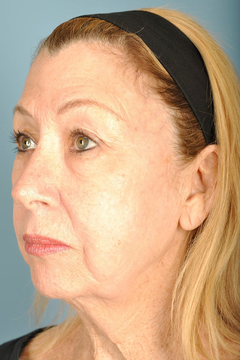 Facelift Before & After Image