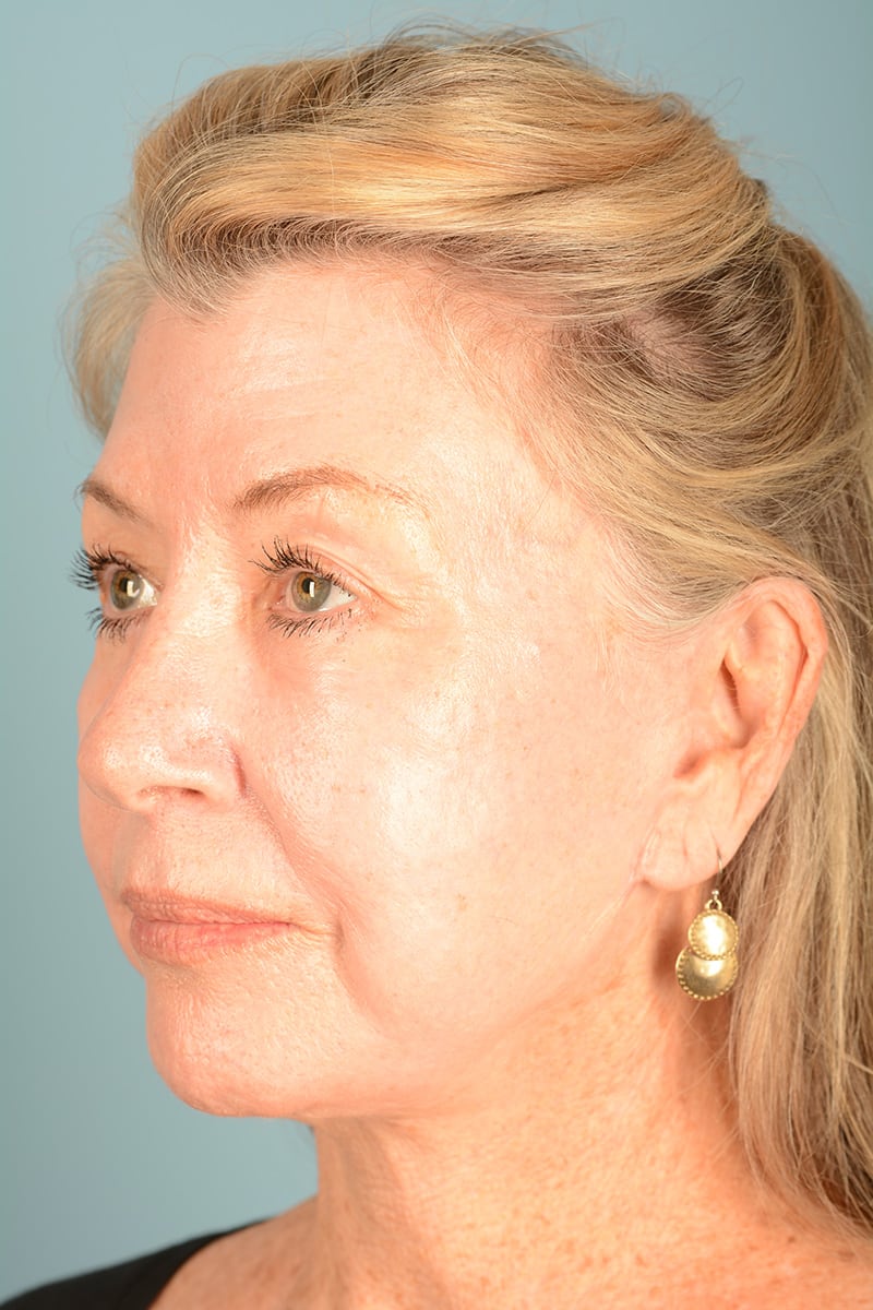 Facelift Before & After Image