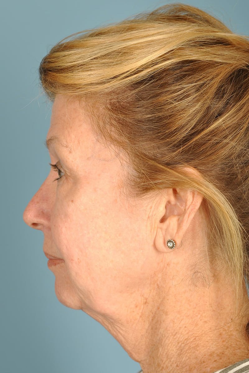 Facelift Before & After Image