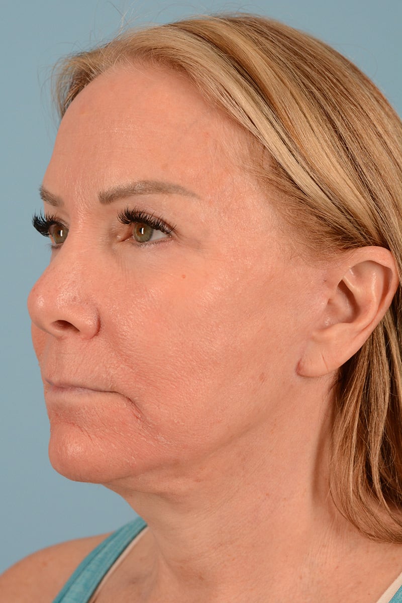 Facelift Before & After Image