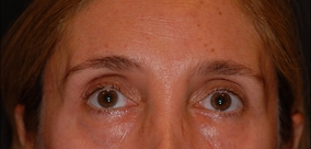 Eye Surgery Before & After Image