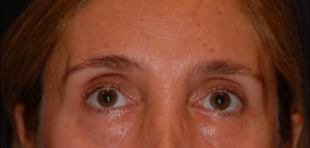 Eye Surgery Before & After Image