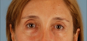 Eye Surgery Before & After Image