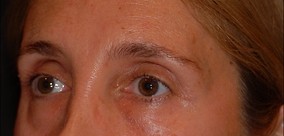 Eye Surgery Before & After Image